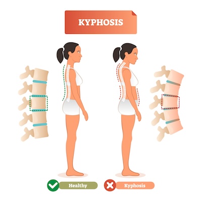 Hunched back of kyphosis diagram