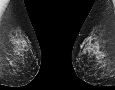 Mammogram image, used with article on breast changes as women age. Mik3812345